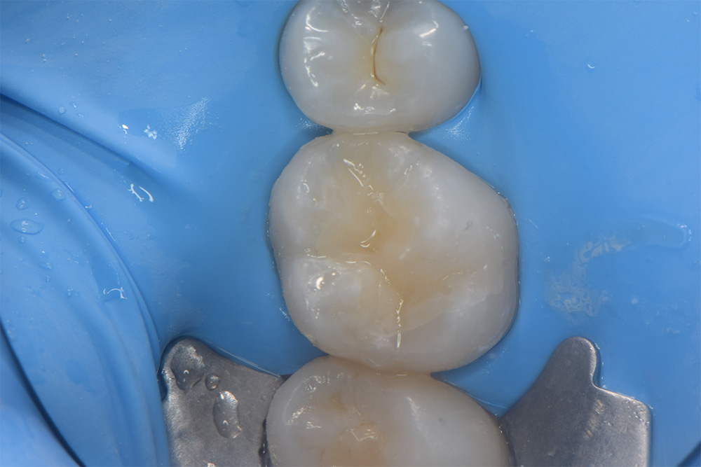 bonded composite cavity filling by singapore dentist
