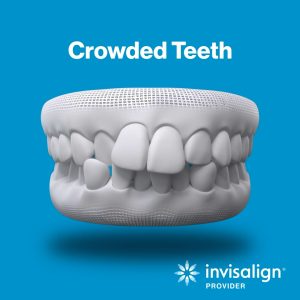 crowded teeth invisalign