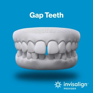 gap teeth invisalign