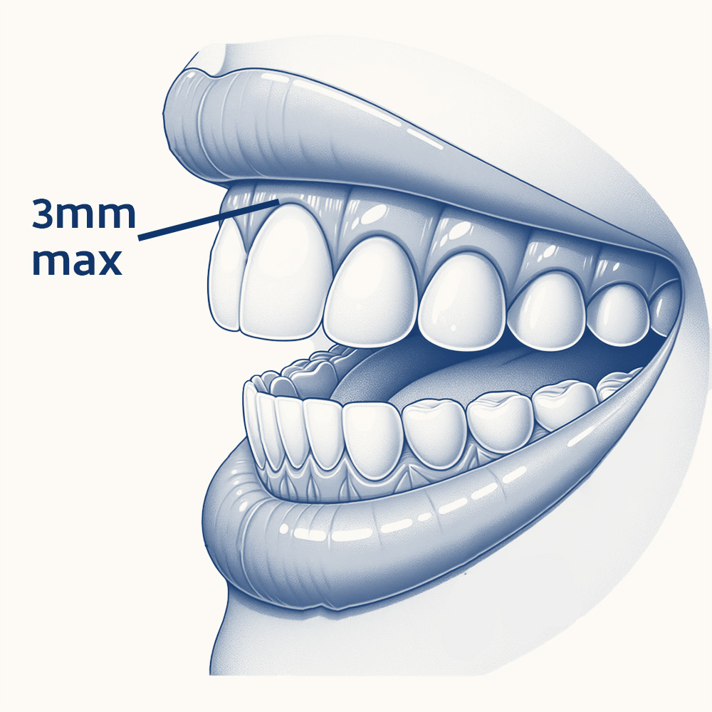 gummy smile 3mm gums infographic