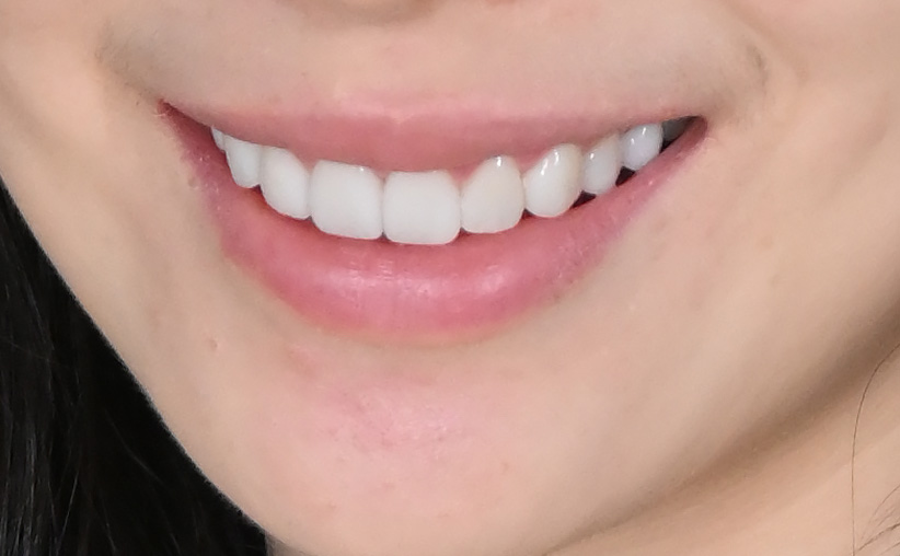 smile makeover with veneers