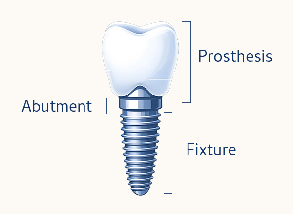 dental implant infographic 600px