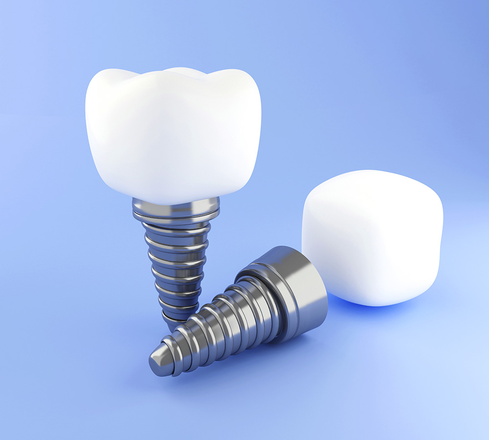 dental implants sample singapore