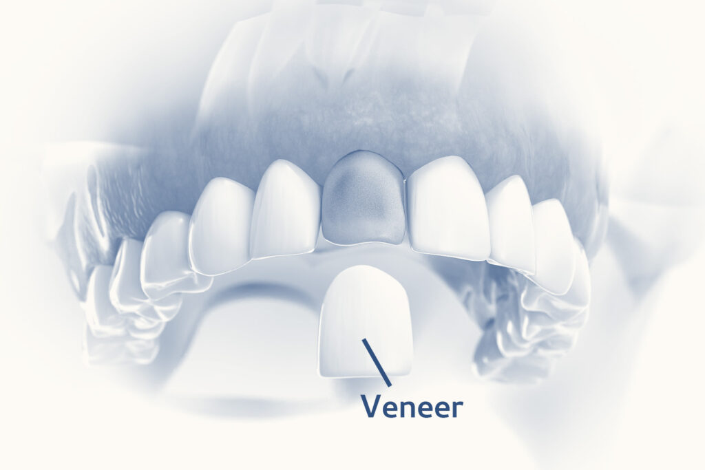 dental veneer gets moved in place