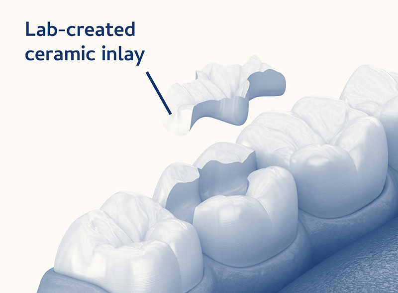 indirect ceramic inlay dental