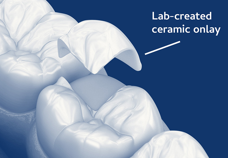 indirect ceramic onlay dental