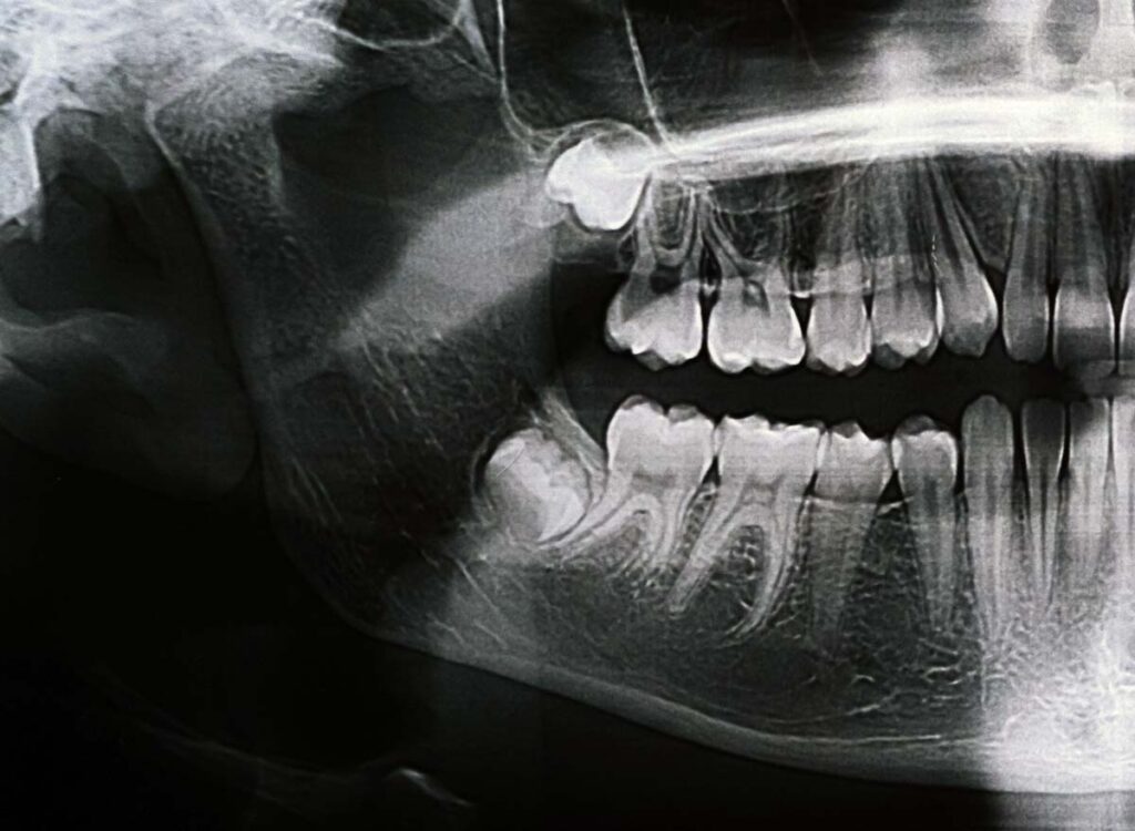 panoramic xray of jaw showing wisdom tooth