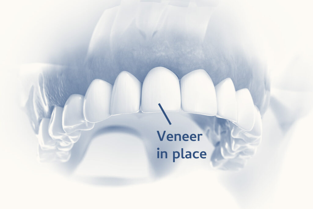dental veneer helps create a nice smile