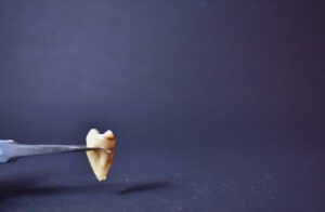 wisdom tooth removal singapore dentist