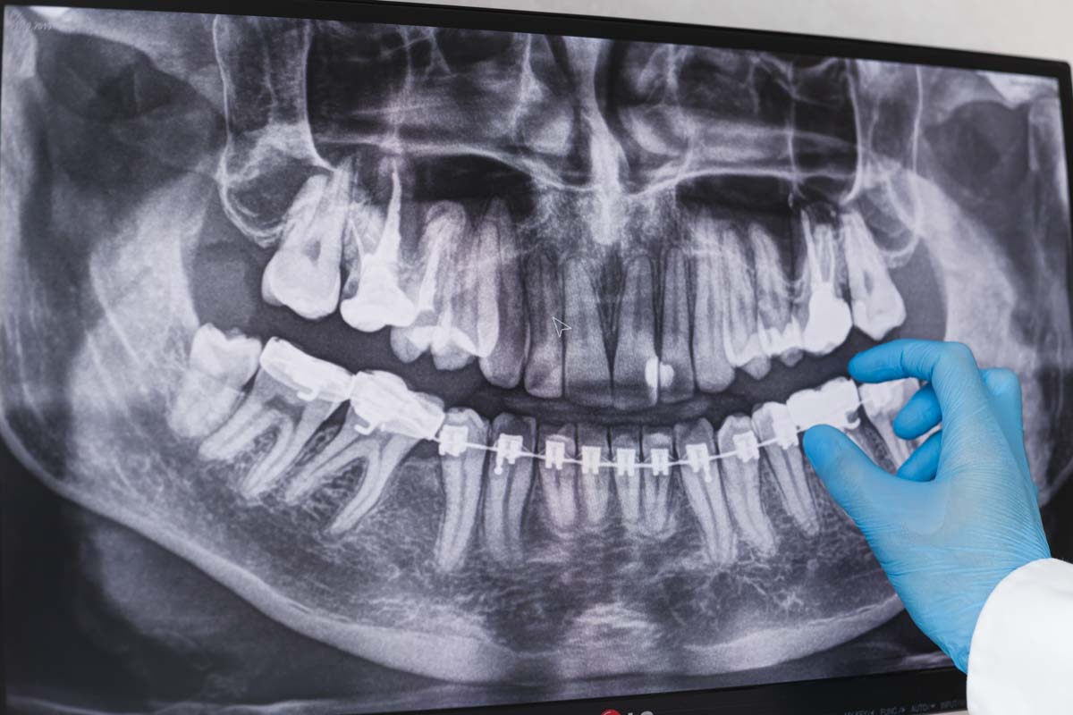 low radiation dental xray (3)