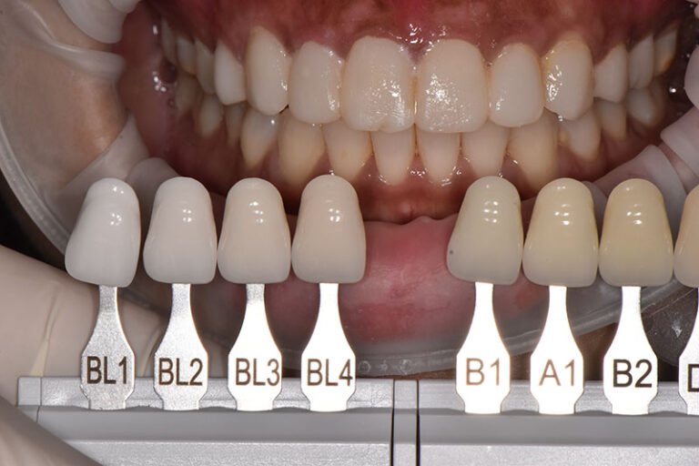 smile makeover with porcelain veneers