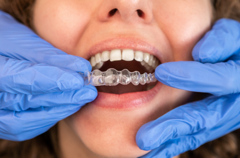 Invisalign for Teens: A Confident, Comfortable Path to a Straighter Smile